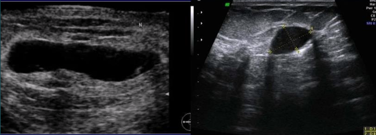 <ul><li><p>benign, routine age-appropriate screening</p></li><li><p>image: cyst</p></li></ul><p></p>