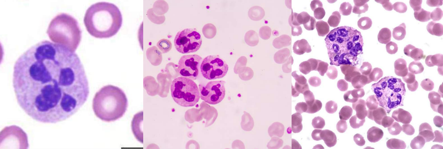 <p>A. Identify the abnormality / cell</p><p>B. This is seen in what condition / disease</p>