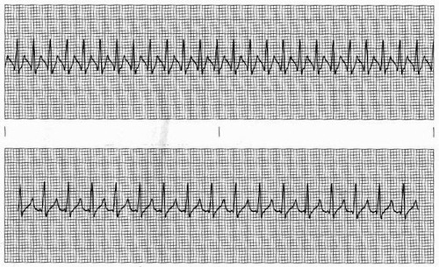 <p>what rhythm is this?</p><p>rate 150-250 plus</p><p>rhythm: regular</p><p>P waves: can have, however can be unable to determine</p><p>PR: unable to measure</p><p>QRS: 0.04-0.12-normal</p><p>causes: caffiene, stress, anxiety, tobacco. Cardiac output is decreased</p><p>TX: bear down to slow heart rate (vasal vagal Maneuver)</p><p>meds: adenosene to slow down and use as a diagnostic</p>