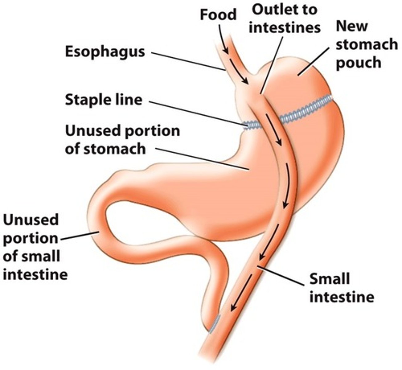 <p>helps lose weight by changing how stomach/small intestine handle food you eat</p><p>-> smaller stomach = feel full with less food</p><p>-> no longer goes into some parts of the stomach and small intestine = body doesn't absorb all calories</p><p>last-ditch effort</p>