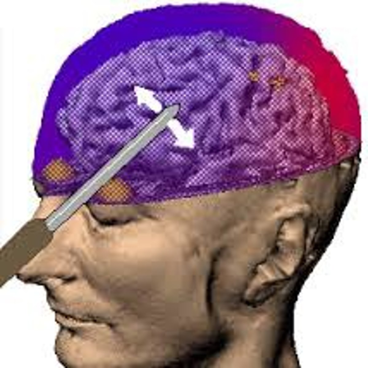 <p>surgery on the brain to try to treat mental disorders (rarely used today).</p>