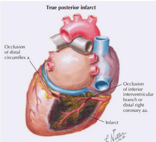 <p>Posterior left ventricle</p>