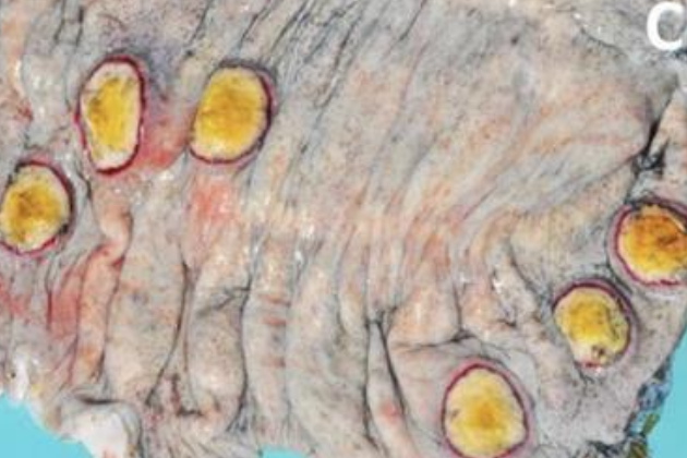 <p>-thickened mucosa with fibronecrotic plaques</p><p>-sheets of fibrin</p><p>-enlarged mesenteric LNs</p><p>-chronic: discrete areas of intestinal necrosis</p><p>-septic: widespread petechiae, secondary sites of infection</p><p>-s. dublin: thickened gallbladder wall</p>