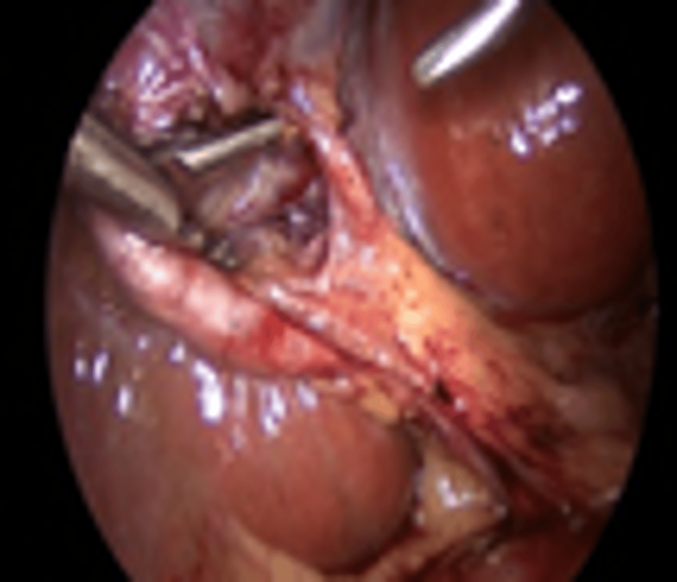 <p>Bile leak; HIDA to check, Tx with ERCP &amp; Stent </p>