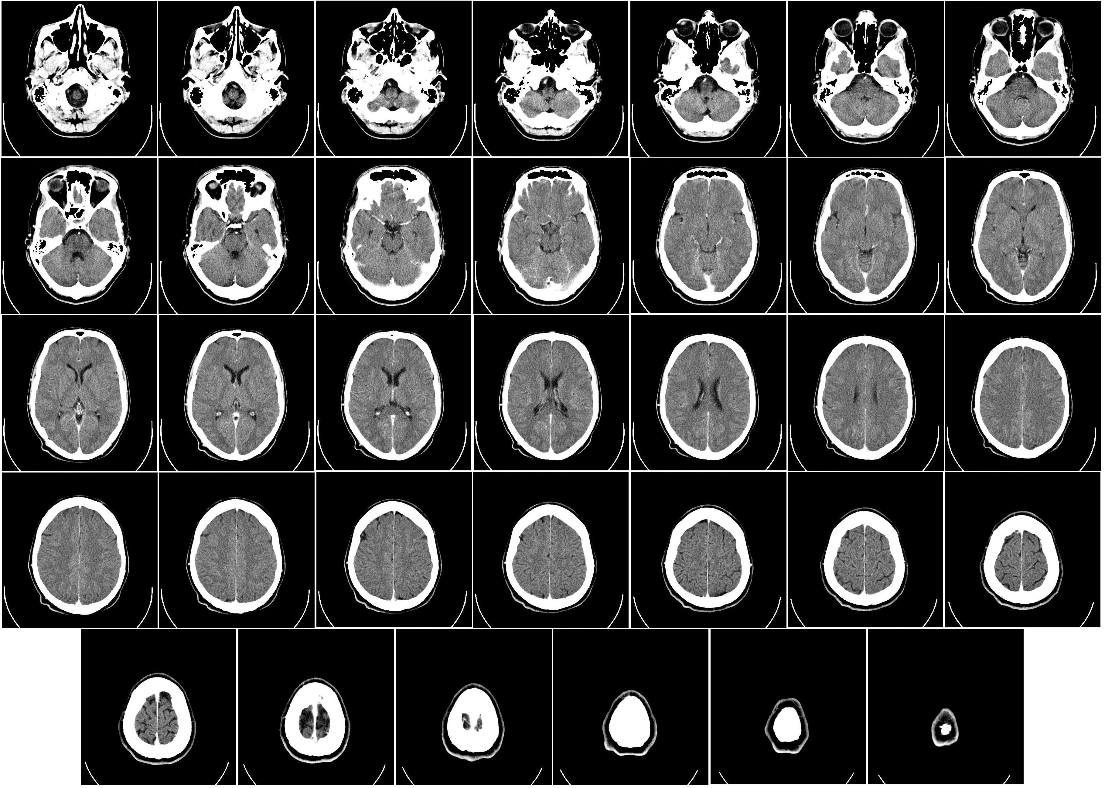 <p><strong>Computer Aided Tomography / CT</strong></p><p>A process that uses a series of x-ray scans to the head in order to reconstruct 2D x-ray images into 3D images of internal organs; The subject enters a donut-shaped x-ray machine</p><p><strong>Measures Tissue Density by X-Ray</strong></p><ul><li><p>Very dense tissue (e.g. Bone) blocks x-rays, so it appears <u>white</u> on the scan</p></li><li><p>Grey matter blocks some x-rays, so it appears <u>light grey</u></p></li><li><p>White matter blocks less x-rays, so it appears <u>dark grey</u></p></li><li><p>The images produced are <u>not as detailed</u> as MRI scans and there is some radiation, but these scans are cheaper than MRI</p></li><li><p>Provides an image for the STRUCTURE of the brain</p></li></ul><p></p>