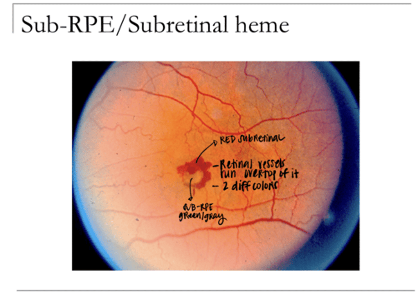 <p>Sub-RPE/Subretinal Heme (Pic)</p>