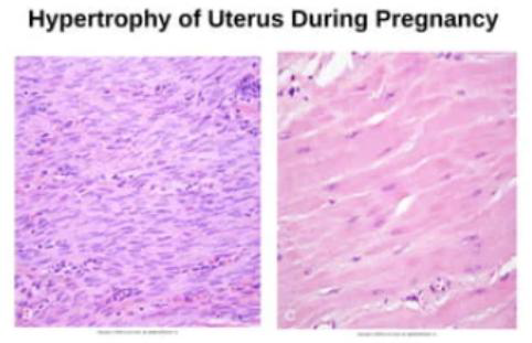 <p>Physiological hypertrophy</p>