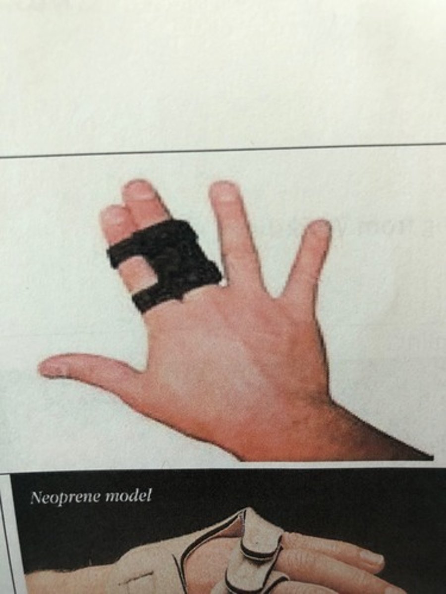 <p>provides PROM, can prevent deformity</p>