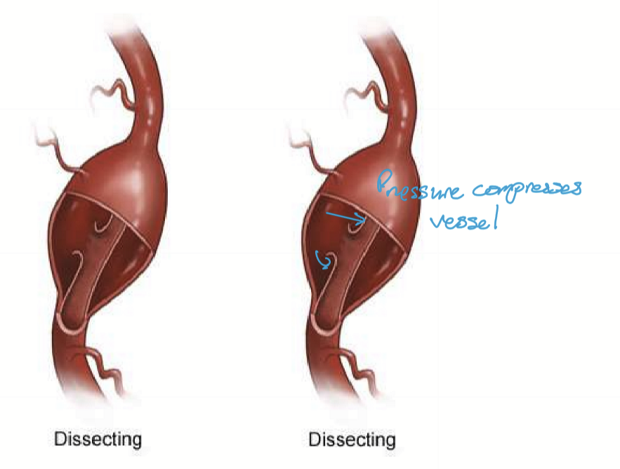 <p>Thunic intima breaks and blood can enter between tunica intima and tunica media. The blood separates the vessel layers. Hematoma can form in the dissected layers → source of emboli. Intima can fall into lumen and cause an occlusion → ischemia/infarct. </p>