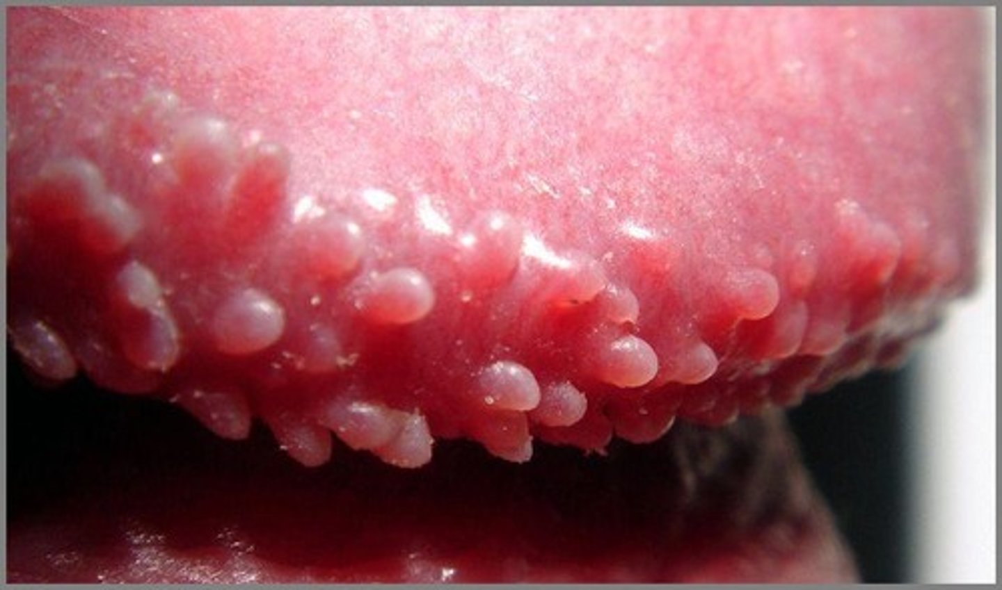 <p>Small skin colored bumps that often form in rows around the glans. Considered a normal anatomic variant, not contagious, and are asx</p><p>Considered harmless, they will decrease with age, but can last throughout ones lifetime</p>