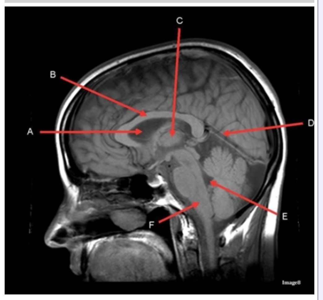 <p><span><strong>&nbsp;Letter E in Image 8 is pointing to:</strong></span></p><p><span>&nbsp;A. Tentorium</span></p><p><span>&nbsp;B. Cerebellum</span></p><p><span>&nbsp;C. Thalamus</span></p><p><span>&nbsp;D. Fourth ventricle</span></p><p><span>&nbsp;E. Medulla oblongata</span></p>