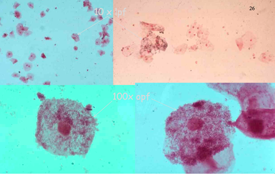 <p>Clue cells = Epi cells with bacteria</p>