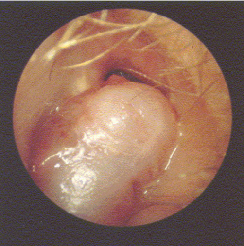 <p><u>disordered otoscopy: canal</u></p><p>polyps</p>