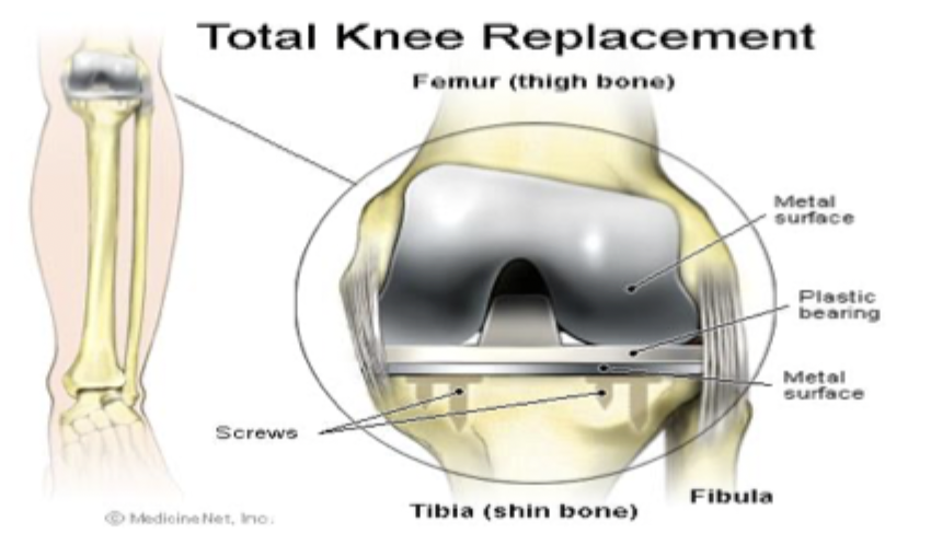 <p>Operative management of OA</p>