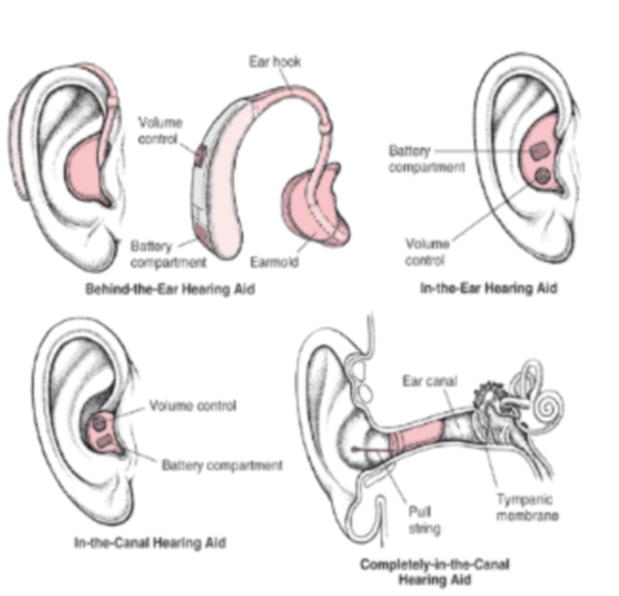 <p>HEARING AIDS</p><p>Behind the ear or in the ear</p><p>Low to high power amplification</p><p>Analogue/digital</p><p>BONE ANCHORED HEARING AIDS (BAHA)</p><p>This is for significant conducting hearing loss</p><p>Surgically implanted (mastoid) titanium base</p><p>Electronic amplification device attachment</p><p>Allows bone transmission of sound</p><p>Indications for this include:</p><p>- Significant conductive hearing loss</p><p>- Intolerance of hearing aids</p><p>- Congenital malformations</p><p>Single sided deafness</p><p>COCHLEAR IMPLANTS</p><p>For profound hearing loss</p><p>Electrically stimulates auditory nerve directly</p><p>NICE recommends implants for adults or children with PROFOUND SENSORINEURAL HEARING LOSS who do not benefit from traditional hearing aid</p><p>Electrode is inserted surgically into cochlea which will directly stimulate the auditory nerve when electrical signals are applied</p><p>Electrode is attached to external auditory processor through skin with magnetic coupler</p><p>Note that the signal is not normal sound which is why intensive therapy is needed to understand new sounds</p><p>The implants will help with lip reading, provision and recognition of environmental sounds and help relief isolation</p>