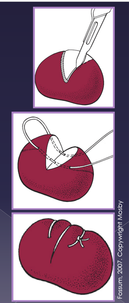 <ul><li><p>indications </p><ul><li><p>regional anatomy concern </p></li><li><p>smaller size of node </p></li><li><p>more difficult location </p></li></ul></li><li><p>aseptic technique </p></li><li><p>stabilize node </p></li><li><p>wedge-shaped incision </p></li><li><p>capsule sutured closed </p></li></ul><p></p>