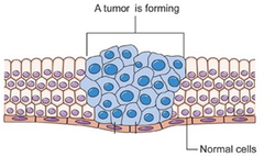 <p>A condition resulting from changes in cells that leads to their uncontrolled growth, division and spread.</p>