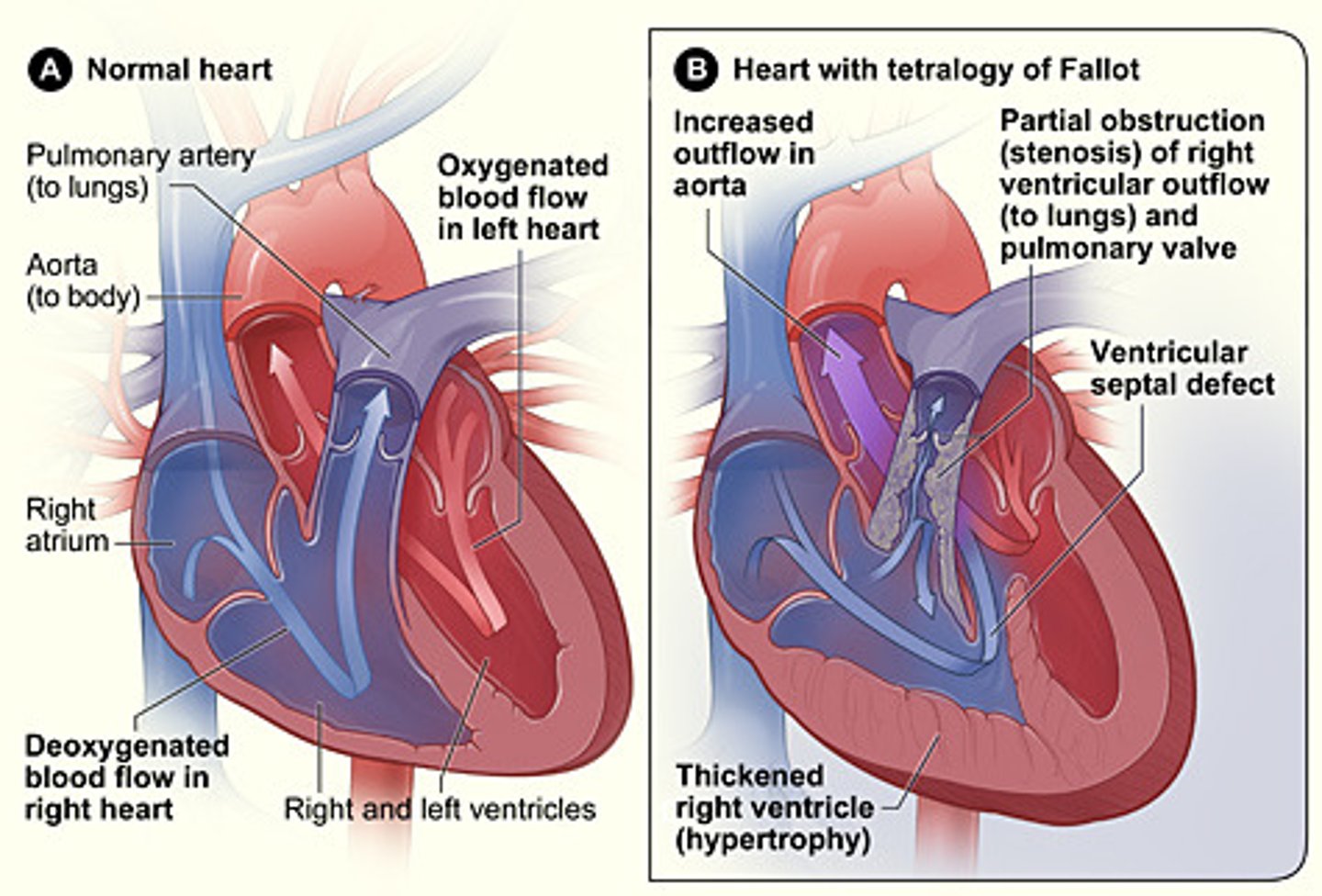 <p>Tetralogy of Fallot</p>