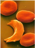 <p>= bloedarmoede: hemoglobine niet mooi in oplossing = vormt lange stugge vezels = geen flexibele rode bloedcellen — stropt op</p><ul><li><p>genetische oorsprong</p></li></ul><p></p>