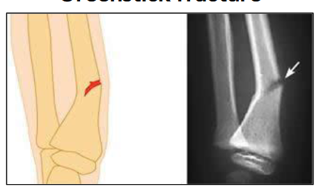 <p>What type of fracture is this? </p>