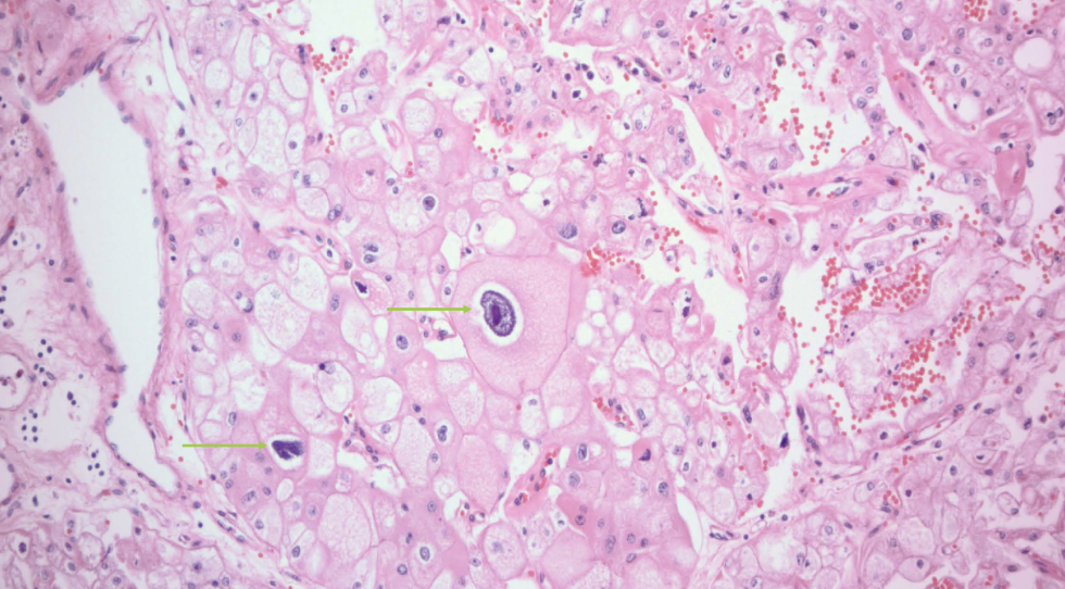 <p>raisinoid nuclei</p>
