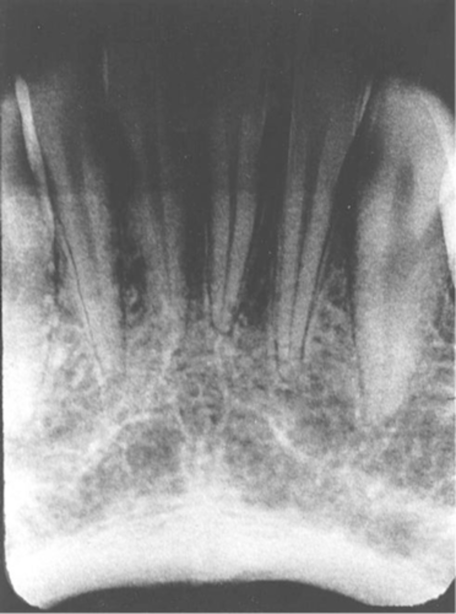 <p>-Image appears dark</p><p>-Exposed to too much radiation, kVp, mA, or a combination of these</p><p>-To prevent check the exposure time, kVp, and mA</p>