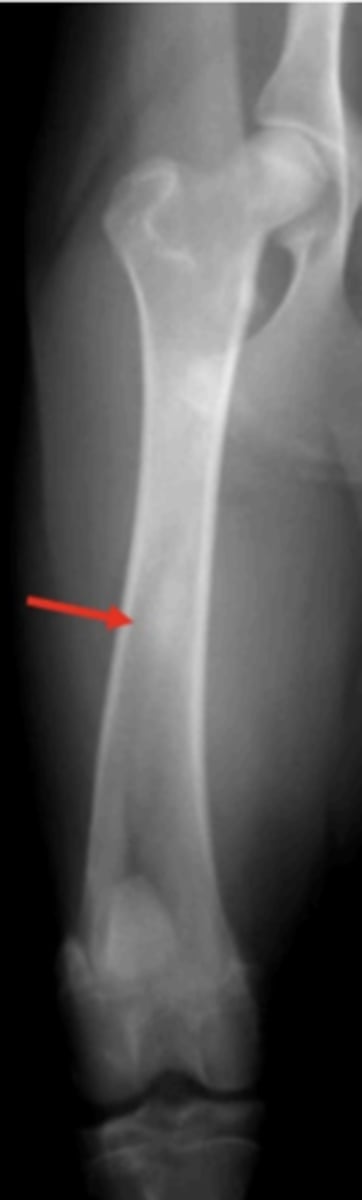 <p>10 y/o German Shepherd comes in with lameness on the right hind leg; what is the radiographic finding?</p>
