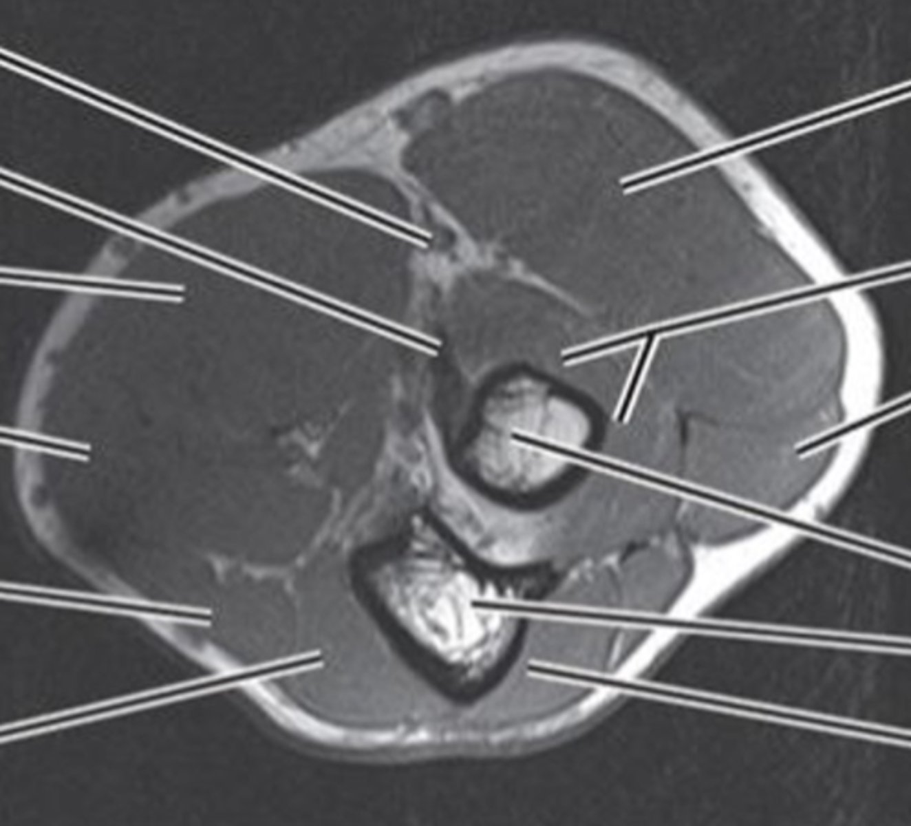 <p>- biceps tendon<br>- triceps tendon<br>- brachial artery<br>- radial/ulnar N</p>