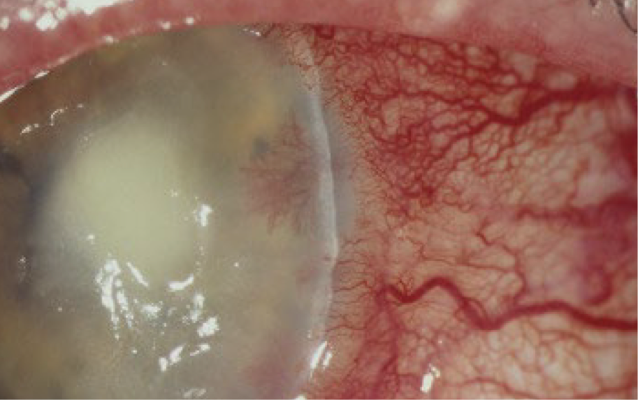 <ul><li><p><strong>Presentation</strong>:</p><ul><li><p><span>Dense stromal infiltration</span></p><ul><li><p><span>Epithelial defect may or may not be present</span></p></li></ul></li><li><p><span>Progressive necrosis with corneal perforation</span></p></li><li><p><span>Anterior uveitis with hypopyon</span></p></li><li><p><span>Increase IOP due to trabeculitis</span></p></li></ul></li></ul><p></p>