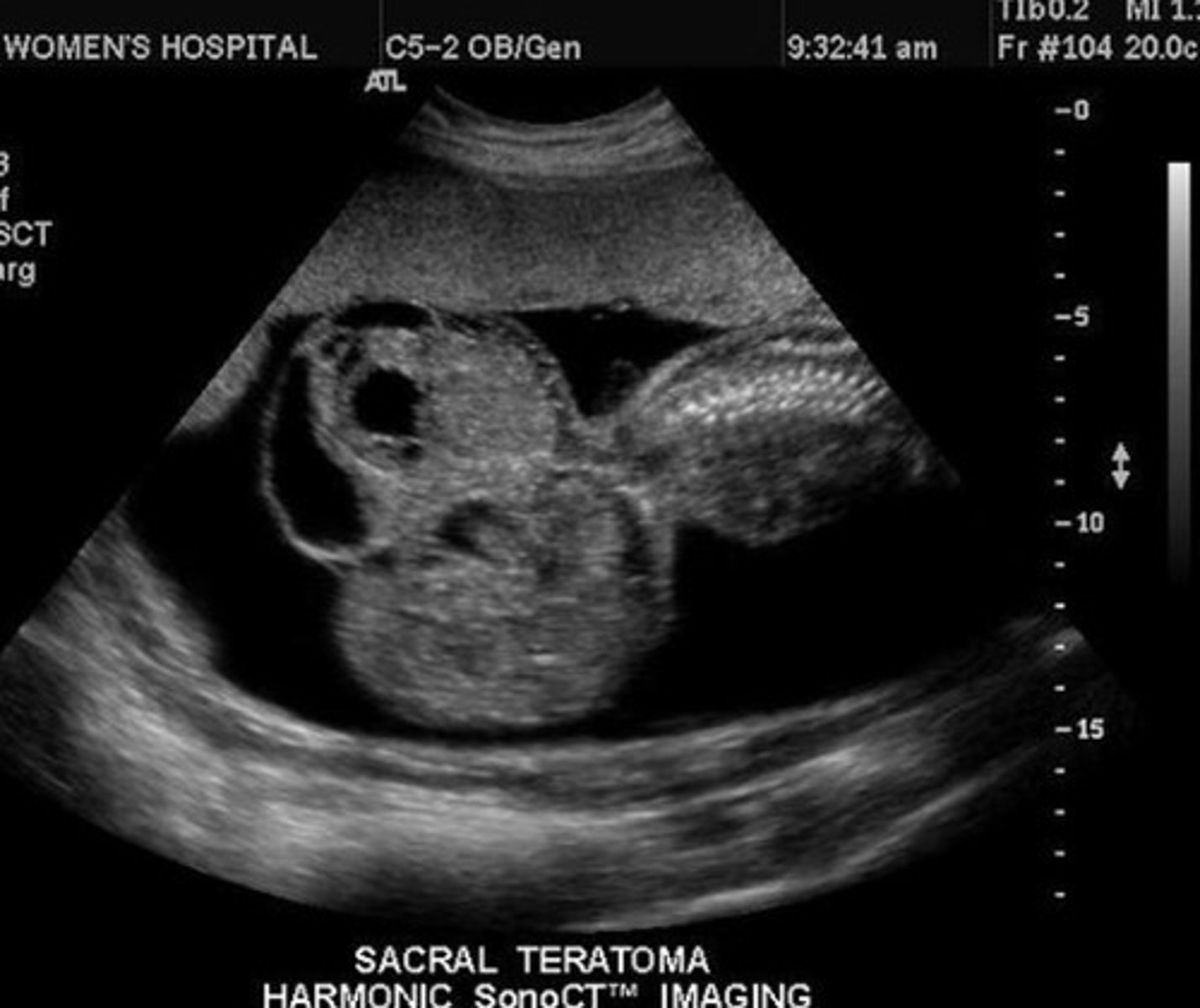 <p>Large complex mass</p><p>Arises from sacral spine</p>