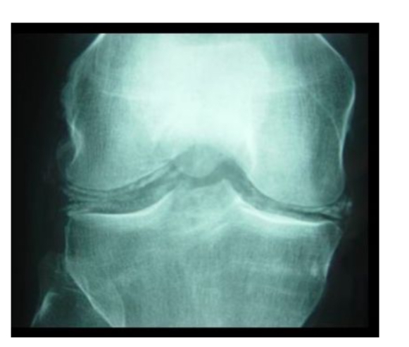 <ul><li><p>calcif linéaires des ménisques </p></li></ul><p></p>
