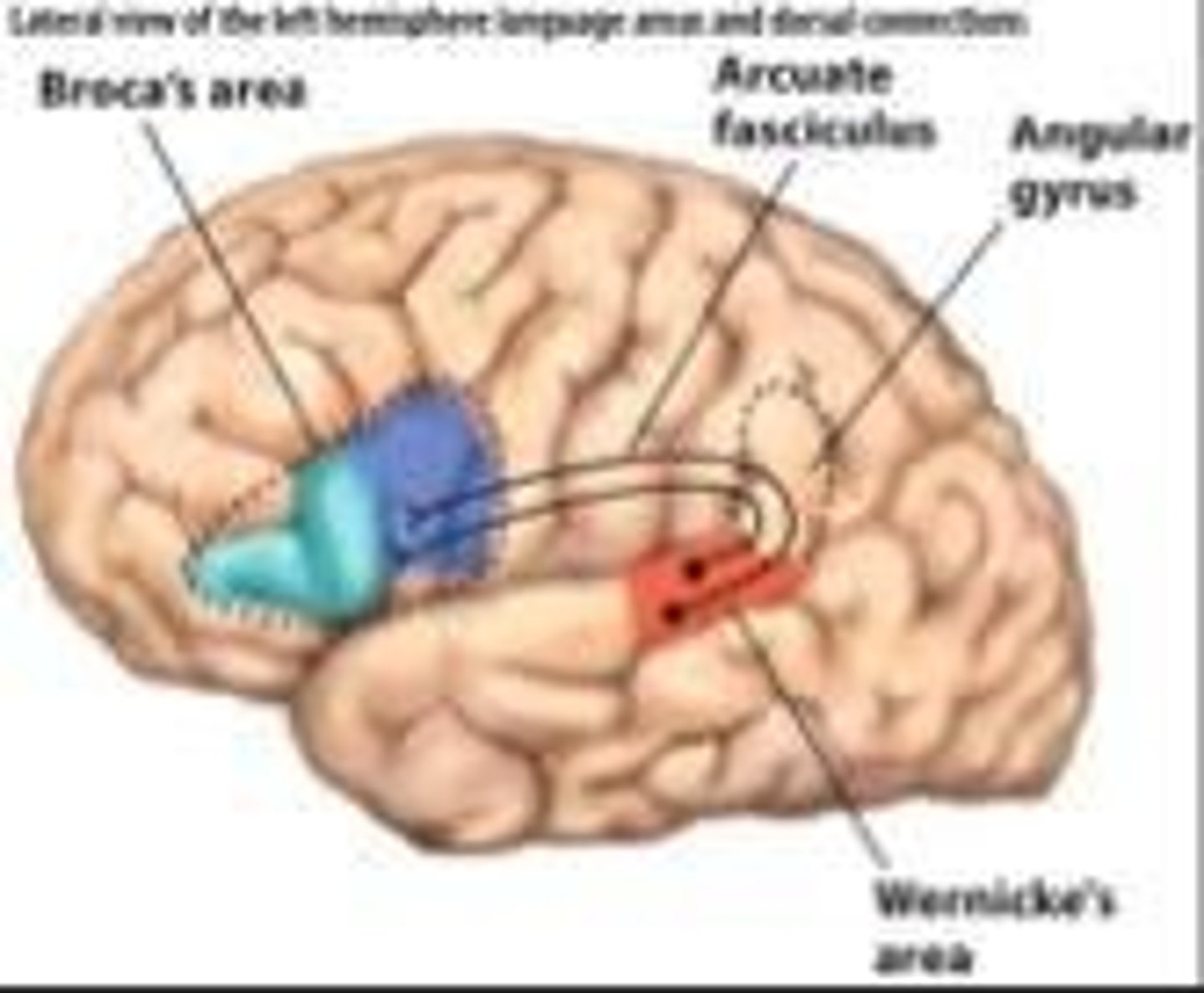 <p>A condition where individuals have problems repeating speech but can understand words, caused by damage to the arcuate fasciculus.</p>