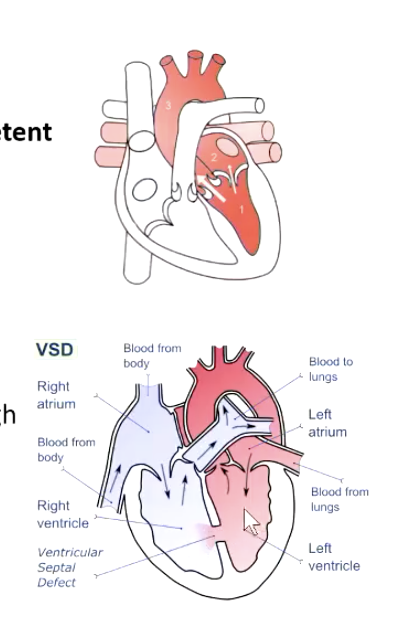 <ul><li><p>regurgitant flow through incompetent mitral or tricuspid valve</p></li><li><p>From left to right ventricle through a ventricular septal defect</p></li></ul><p></p>