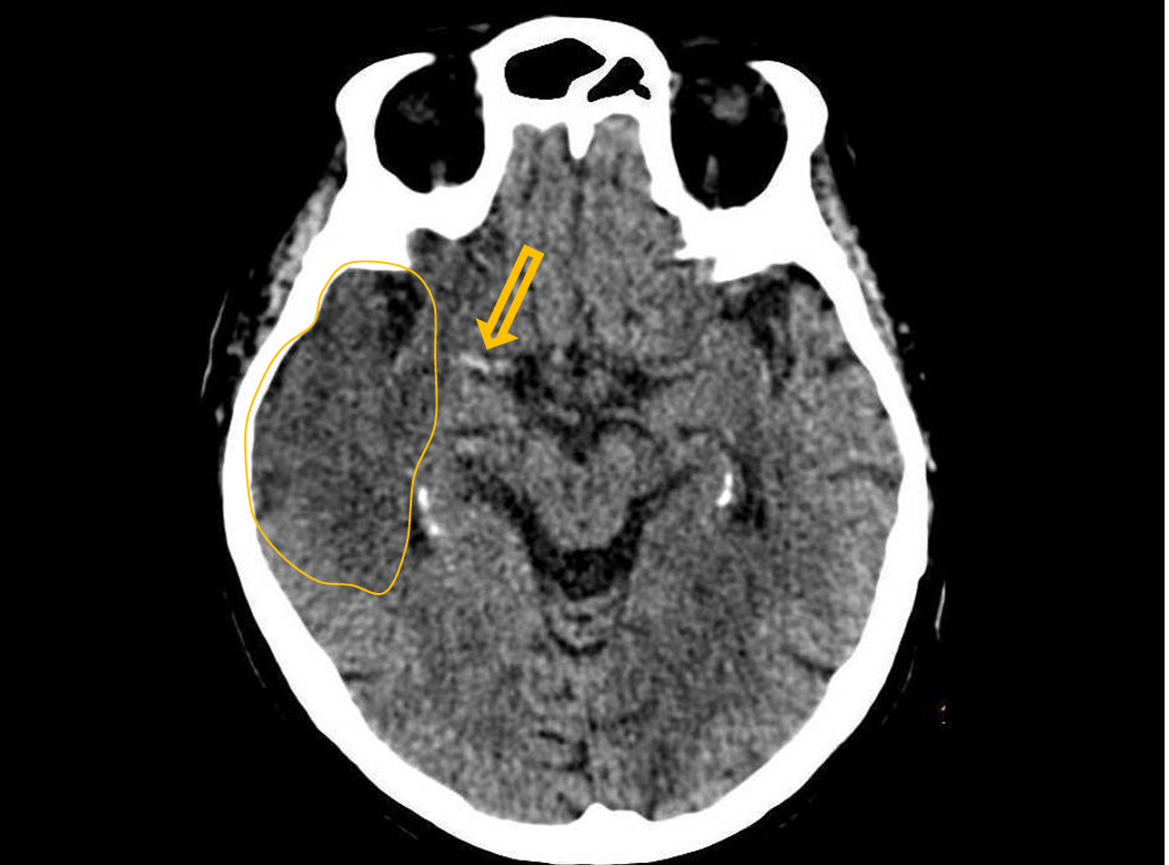 <p>Patient history: epilepticseizure, hallucination, suddenmemoryimpairment </p><p>Modality: non-enhanced CT, brain window setting (window level: 40 HU; window width: 80 HU) </p><p>Region: brain, axial view </p><p>Radiologic sign: Cortical-subcortical border disappeared/blurred due to edema (blue area), “hyperdense media”-sign – thrombosis of the right middle cerebral artery (yellow arrow). </p><p>Diagnosis: acute/subacute ischaemia in the territory of the right MCA</p>
