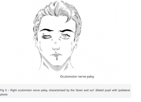 <ul><li><p>Condition resulting from damage to oculomotor nerve — most common structural causes —</p><ul><li><p>Raised intracranial pressure (compresses the nerve against temporal bone) </p></li><li><p>Posterior communicating artery aneurysm</p></li><li><p>Cavernous sinus infection</p></li><li><p>Trauma </p></li></ul></li><li><p>Other pathological causes —</p><ul><li><p>Diabetes, multiple sclerosis, myasthenia gravis, &amp; giant cell arteritis</p></li></ul></li><li><p>Symptoms —</p><ul><li><p>Ptosis — drooping upper eyelid, due to paralysis of levator palpebrae superioris &amp; unopposed activity of orbicularis oculi muscle</p></li><li><p>“Down &amp; out” position of eye at rest — due to paralysis of superior, inferior, &amp; middle rectus, and inferior oblique (therefore the unapposed activity of lateral rectus &amp; superior oblique) — leading patient to be unable to elevate, depress, or adduct the eye</p></li><li><p>Dilated pupil — due to unopposed action of dilator pupillae muscle</p></li></ul></li></ul>