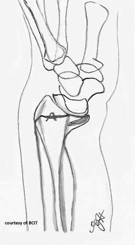 <p>Reverse Colles’ with palmar (anterior) displacement, caused by falling on a flexed wrist.</p>