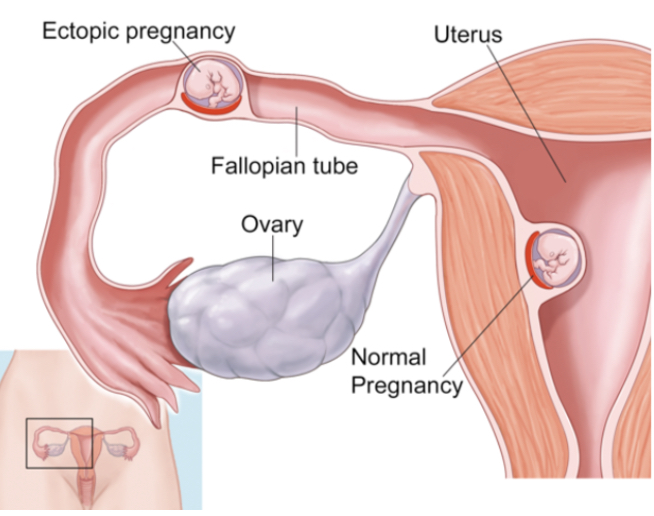 <p><strong>implantation</strong> of the fertilized ovum <strong>outside </strong>of the uterine cavity, most commonly in a <strong>fallopian tube</strong></p><ul><li><p>the fetus is <strong>not viable</strong>, and <strong>salpingectomy</strong> is performed to<strong> remove</strong> both the <strong>embryo</strong> and the <strong>fallopian tube</strong></p></li></ul><p></p>