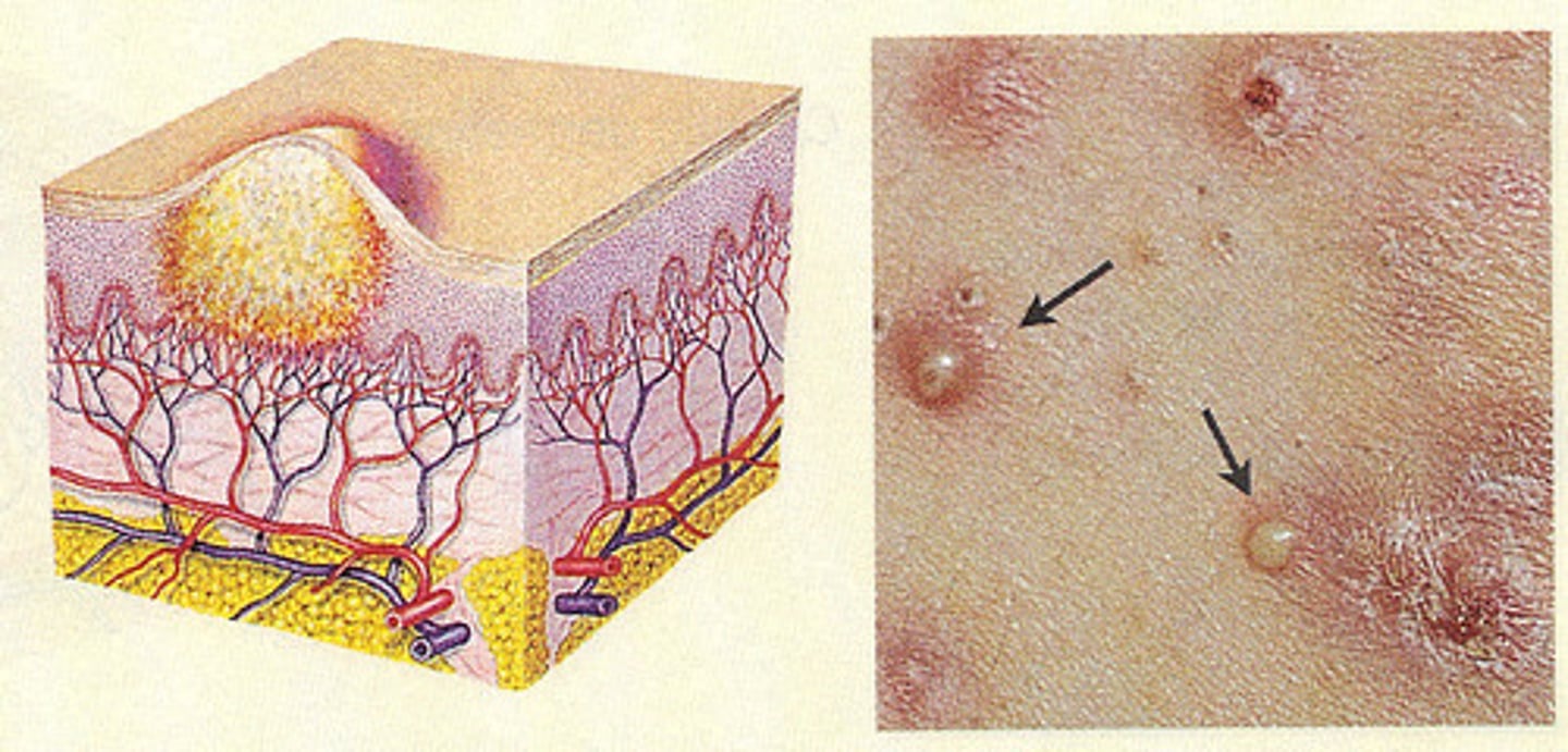 <p>turbid fluid (pus) in cavity; circumscribed and elevated; ex - impetigo, acne</p>