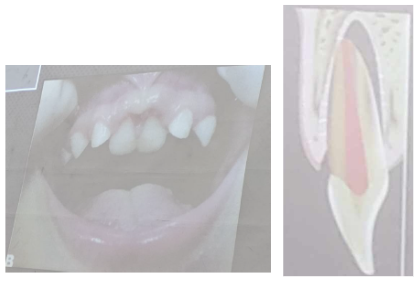 <ul><li><p><span>desplazamiento del diente en una dirección vestibular palatina o lateral. Suele existir fractura del alvéolo</span></p><ul><li><p><span>La mayoría se desplazan con la corona hacia palatino y el ápice hacia labial</span></p></li></ul></li></ul><p></p>