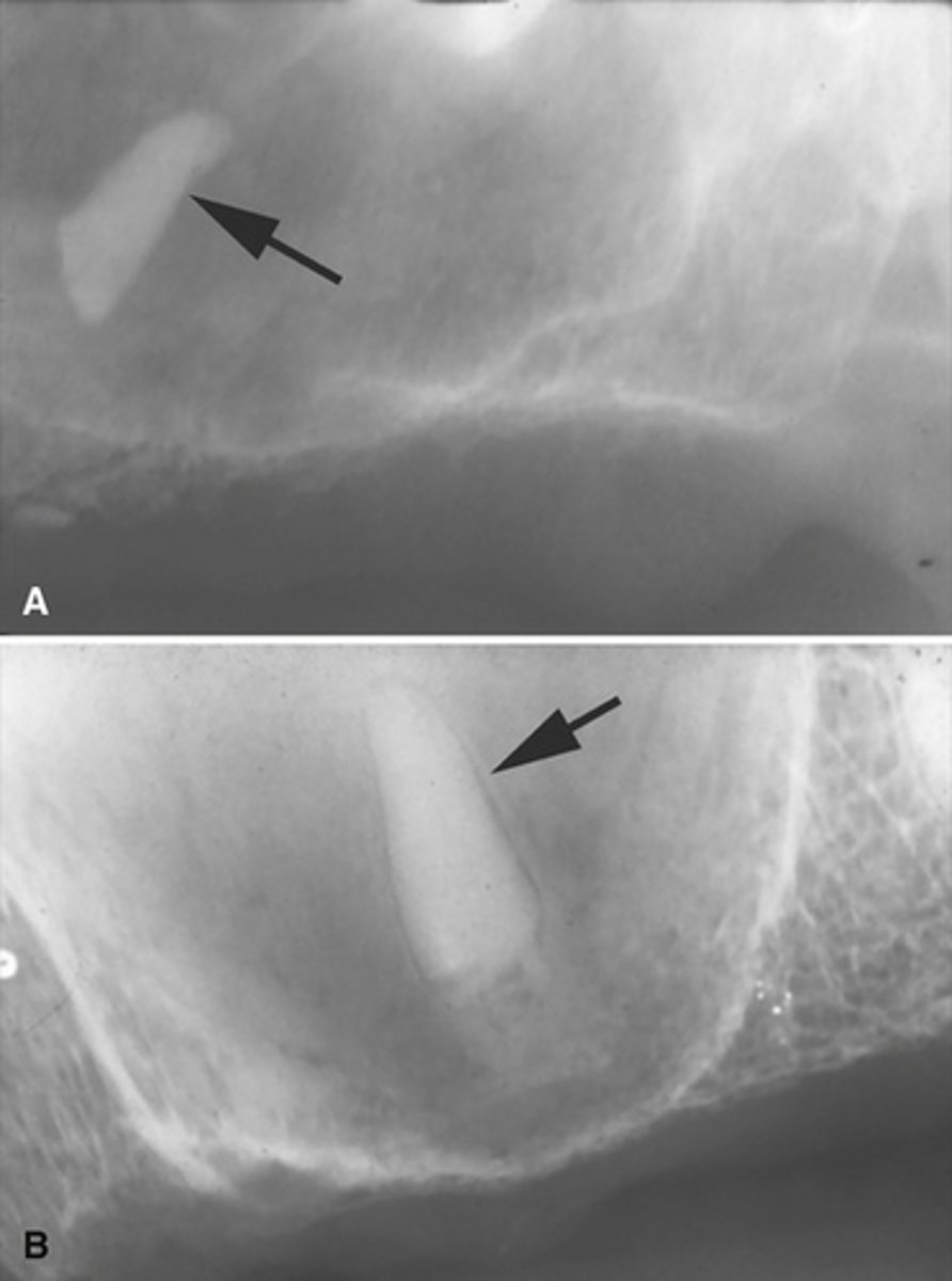 <p>How can you differentiate this from an antroliths in the maxillary sinus?</p>