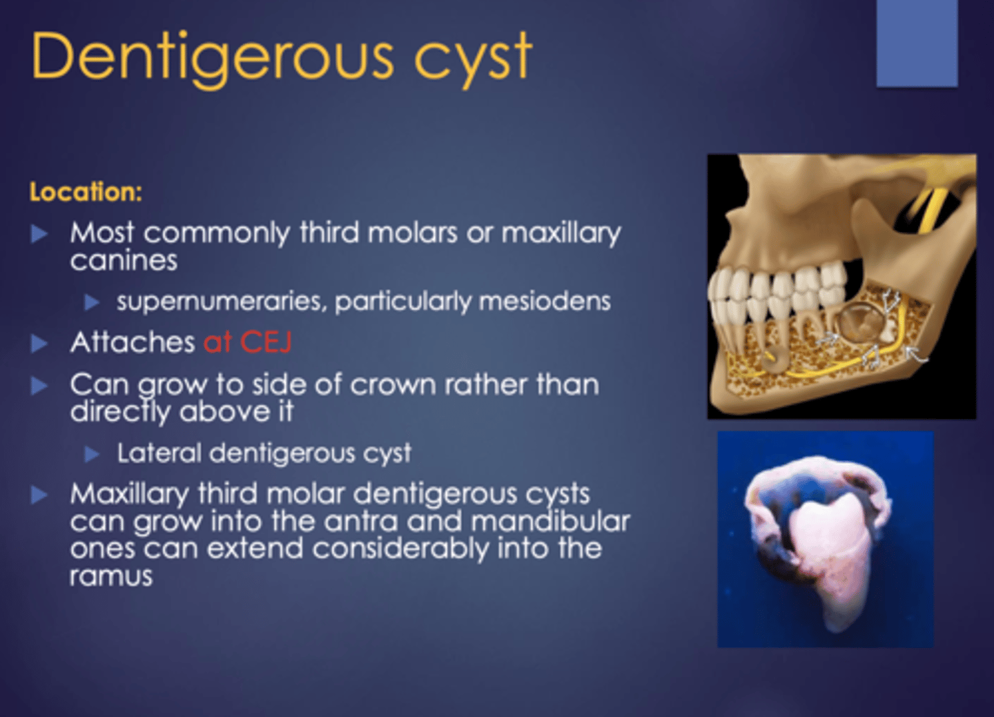 <p>Dentigerous Cyst</p>