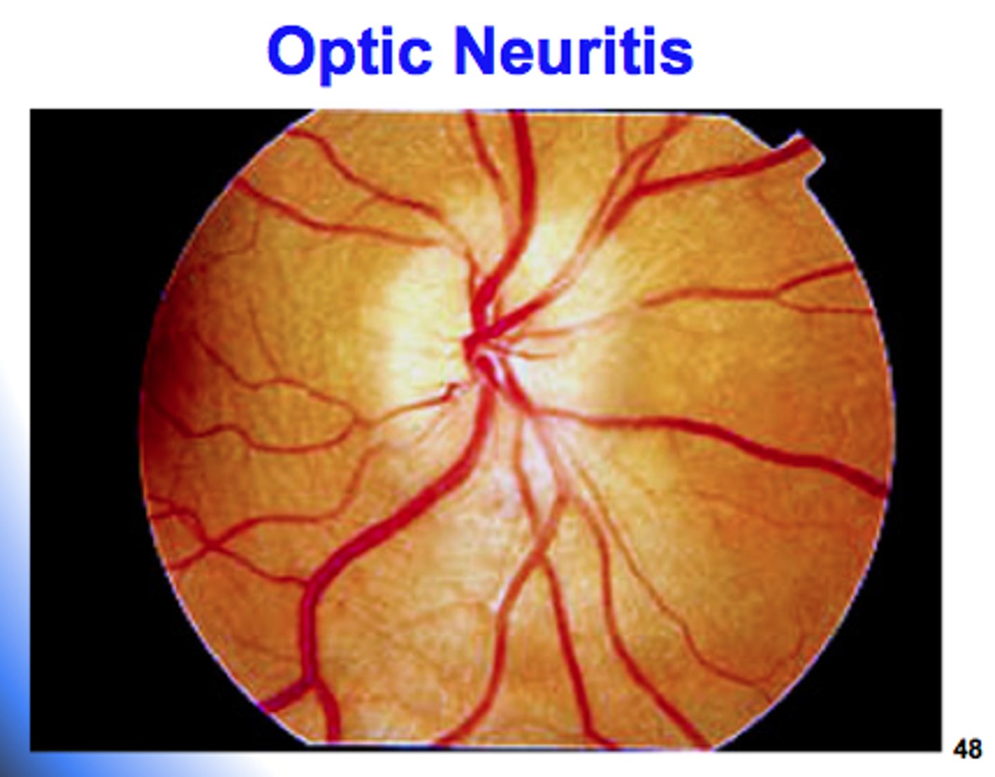 <p>monocular painful vision loss that occurs over hours to days and lasts a few weeks<br>-Changes in VA can range from mild to severe<br>-Orbital pain occurs in 92% of patients and usually worse with extraocular movement<br>-Visible optic disc swelling in 1/3 of patients<br>-Internuclear ophthalmoplegia occurs in about 30% of patients<br><br>related to MS</p>