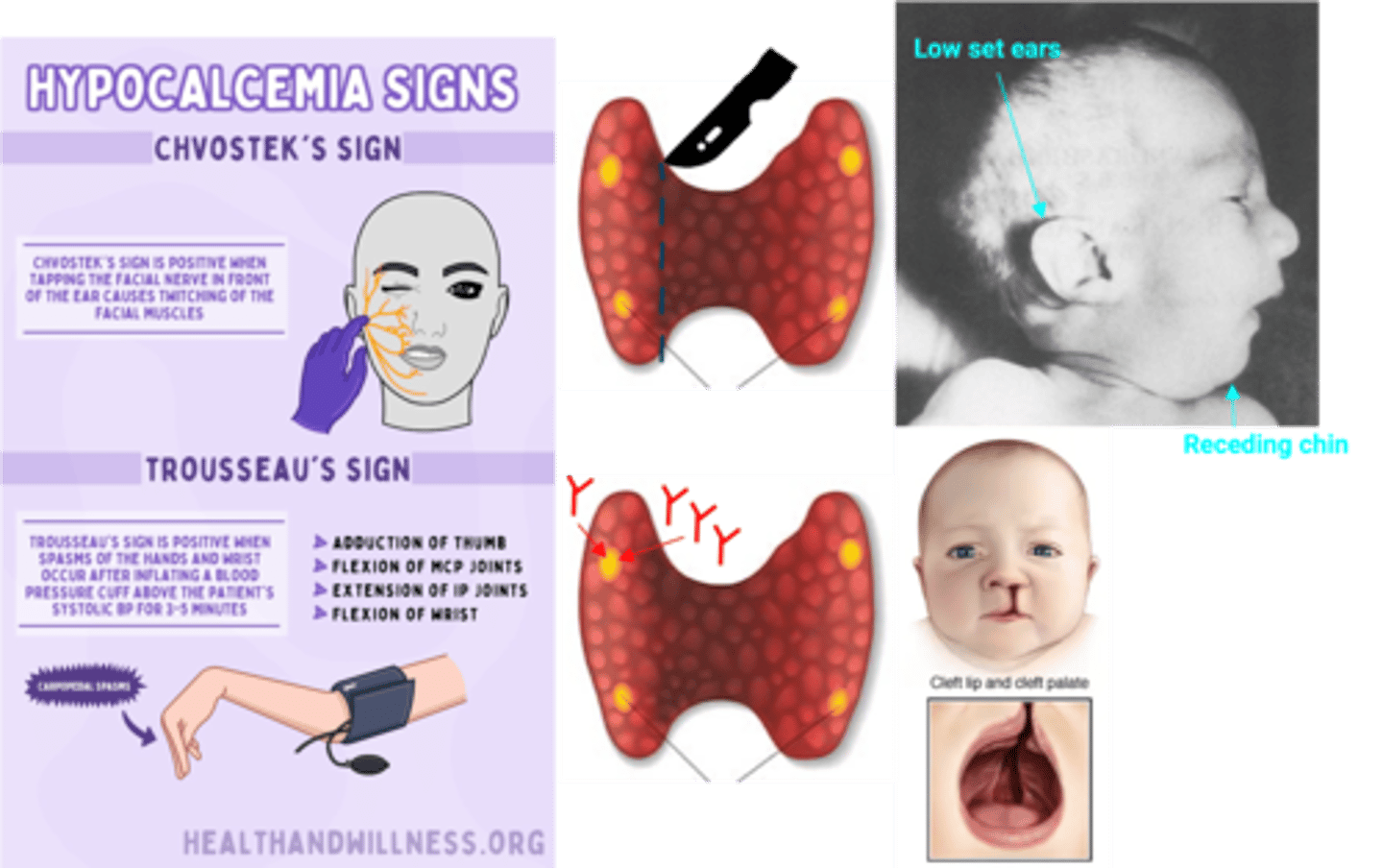 <p>Define Condition:</p><p>Underproduction of PTH --&gt; Low Serum Ca</p><p>-Hx/Path: Parathyroid destruction/damage</p><p>&gt; Surgical Ablation (MC = Accidental removal/damage of PTHs during thyroid/neck surgery)</p><p>&gt; Autoimmune HypoPTH = Autoimmune Polyendocrine Syndrome (APS) Type I</p><p>&gt;&gt; Mutations in Autoimmune Regulator (AIRE) gene</p><p>&gt;&gt; Autosomal RECESSIVE</p><p>&gt;&gt; Triad</p><p>&gt;&gt;&gt; HypoPTH</p><p>&gt;&gt;&gt; Addison disease (Adrenal Insufficiency)</p><p>&gt;&gt;&gt; Chronic mucocutaneous candidiasis</p><p>&gt; DiGeorge Syndrome ("CATCH-22)</p><p>&gt;&gt; Deletion of c/s 22q11 --&gt; 3rd and 4th pharyngeal pouches develop</p><p>&gt;&gt; 3rd pouch --&gt; Thymus + 2 Inferior PTHs</p><p>&gt;&gt; 4th pouch --&gt; 2 superior PTHs</p><p>&gt;&gt; Cardiac Abns (TOF)</p><p>&gt;&gt; Abn Facies</p><p>&gt;&gt; Thymic aplasia/hypoplasia --&gt; recurrent Infex</p><p>&gt;&gt; Cleft Palate</p><p>&gt;&gt; HypoPTH</p><p>-Sx/PE: Hypocalcemia</p><p>&gt; Up findings --&gt; NM irritability ==&gt; Muscle tetany, spasms, hyperreflexia, tingling</p><p>&gt; Chvostek Sign = Tap facial nerve (tap Cheek) ==&gt; Contraction of facial muscles</p><p>&gt; Trousseau Sign = Occlusion of brachial artery w/ BP cuff (cut off Triceps) ==&gt; Carpal Spasm</p>