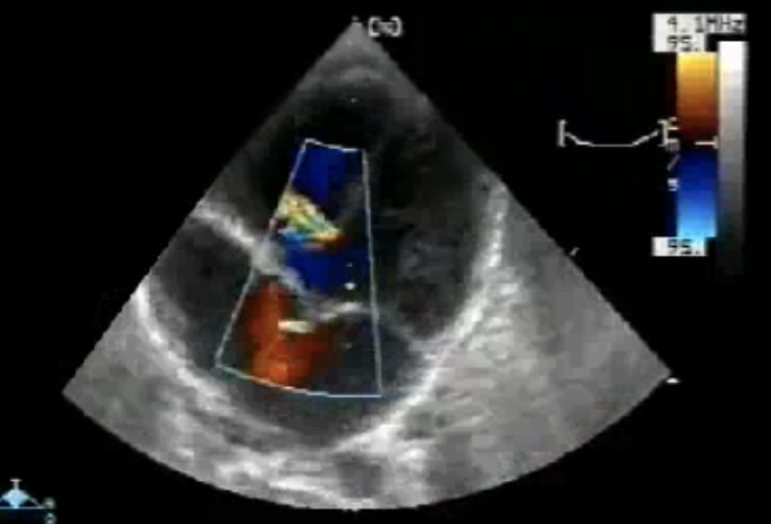 <p>History of systolic murmur</p>