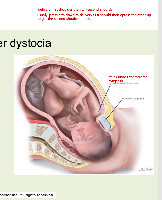 <ul><li><p>head is born but the anterior shoulder cannot pass under the pubic arch</p></li><li><p>fetopelvic disproportion caused by excessive fetal size (greater than 4000g)</p><ul><li><p>macrosomia</p></li></ul></li><li><p>pelvic abnormalities</p></li><li><p>prolonged second stage of labour</p></li><li><p>history of shoulder dystocia with a previous birth</p></li></ul><p></p>