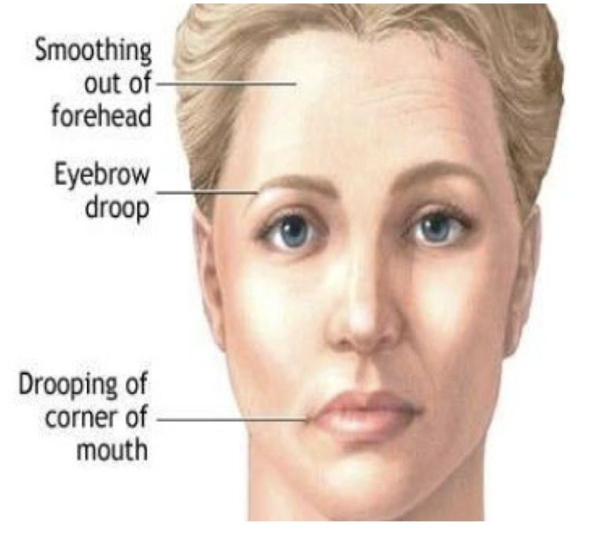 <ul><li><p>Diagnostic Test: Ice Pack Test </p><ul><li><p>Take baseline ptosis » ice pack for 2-5 min » take ptosis measurement</p></li><li><p>Less ptosis/improvement ≥ 2mm = Positive Ice Pack Test </p></li></ul></li><li><p>First S/S:</p><ul><li><p>Ocular (and bulbar) muscles affected first </p><ul><li><p>Diplopia </p></li><li><p>Bilateral Ptosis </p></li></ul></li></ul></li></ul><p></p>