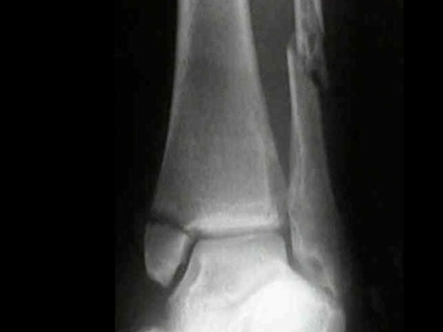 <p>- caused by a direct blow to the outside of the leg</p>