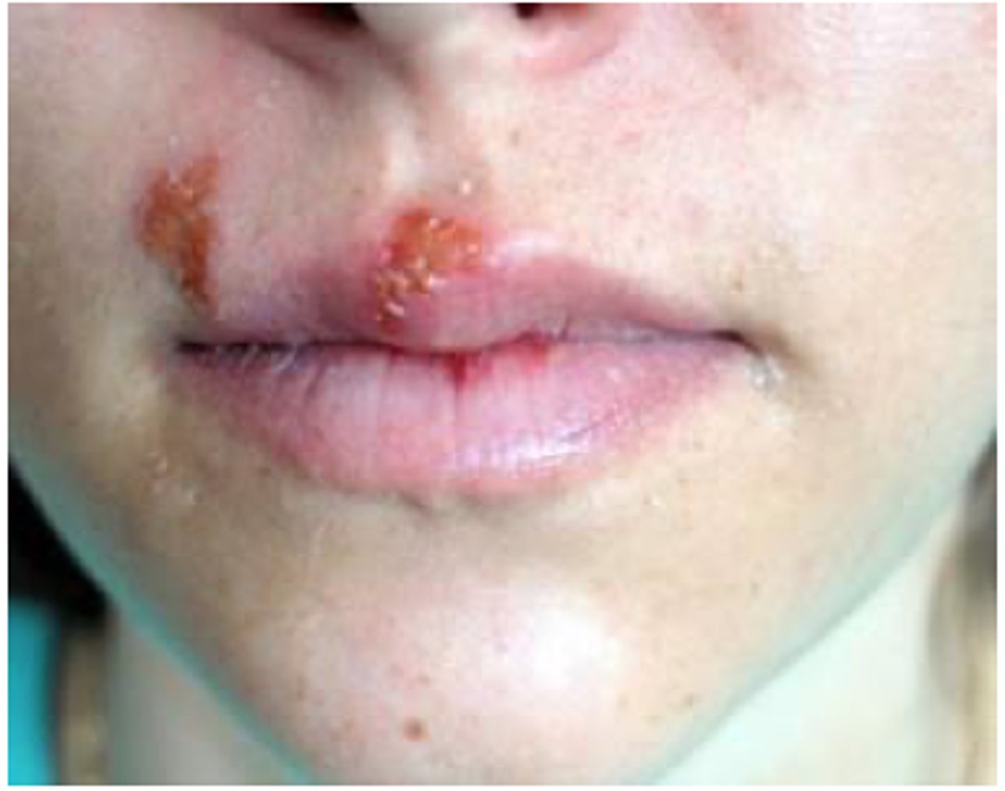 <p>diagnose this image:</p><p>Herpetic appearance: vesicles on erythematous base, progresses to tender ulcers that crust and scab over</p>