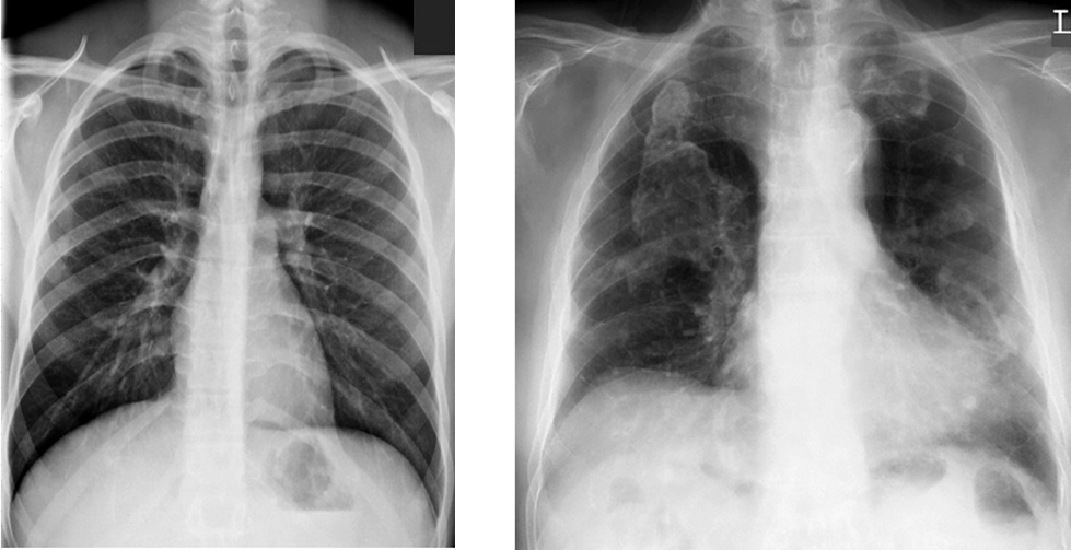 Left image is normal