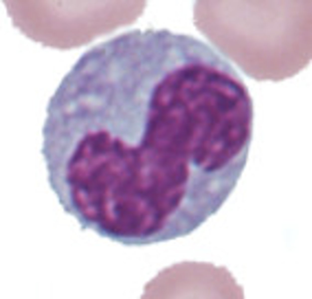 <p>Toxic changes in neutrophils</p><p>- streaky diffuse blue appearance to cytoplasm</p>